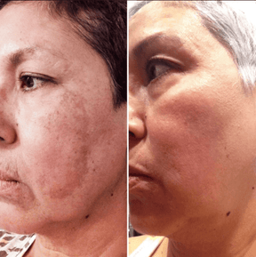 Melasma Laser Peel - Spectra Q Switch - Skin Perfect Brothers Powered by VLA
